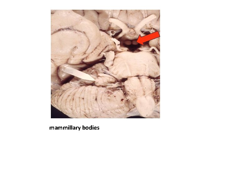 mammillary bodies 