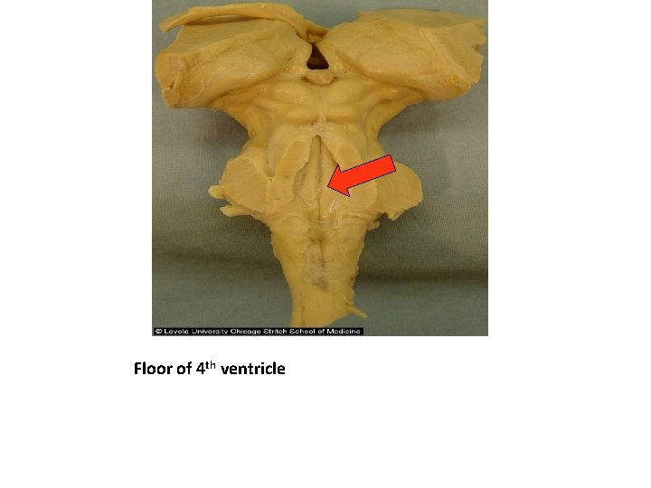 Floor of 4 th ventricle 