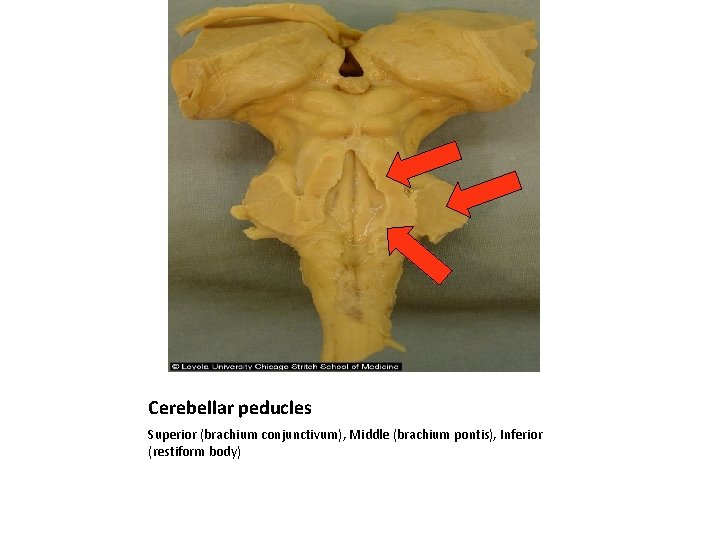 Cerebellar peducles Superior (brachium conjunctivum), Middle (brachium pontis), Inferior (restiform body) 