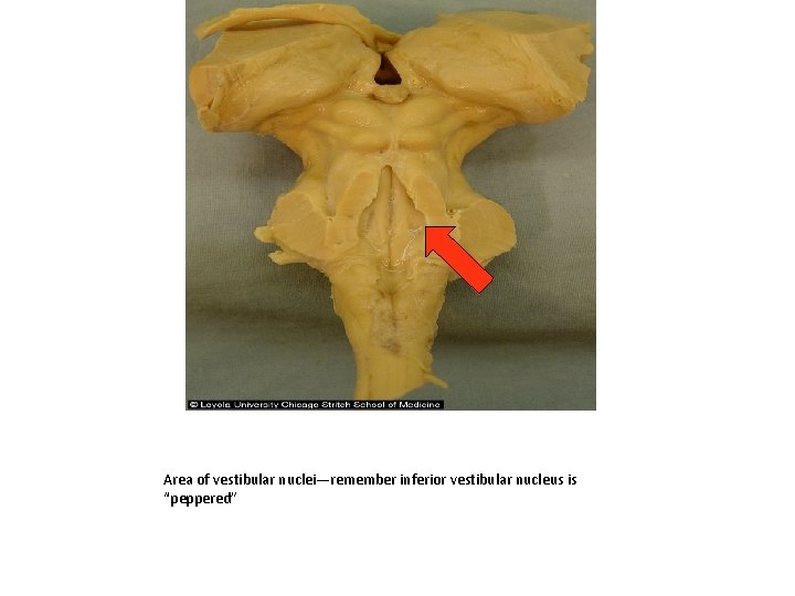 Area of vestibular nuclei—remember inferior vestibular nucleus is “peppered” 