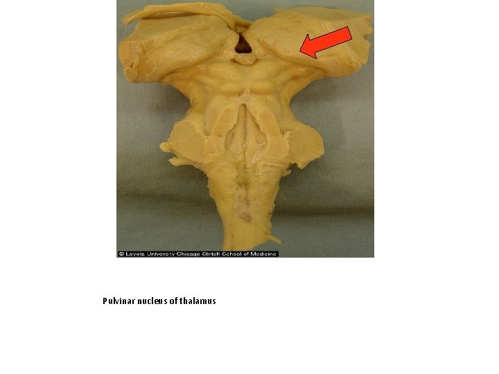 Pulvinar nucleus of thalamus 