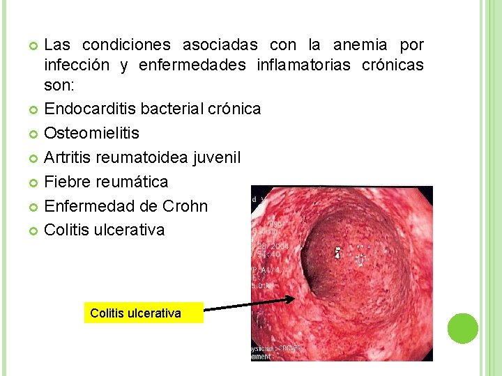 Las condiciones asociadas con la anemia por infección y enfermedades inflamatorias crónicas son: Endocarditis