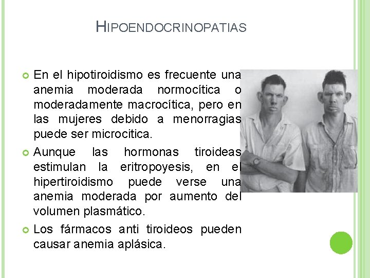 HIPOENDOCRINOPATIAS En el hipotiroidismo es frecuente una anemia moderada normocítica o moderadamente macrocítica, pero