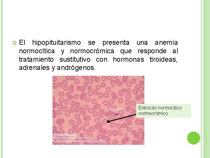  El hipopituitarismo se presenta una anemia normocítica y normocrómica que responde al tratamiento