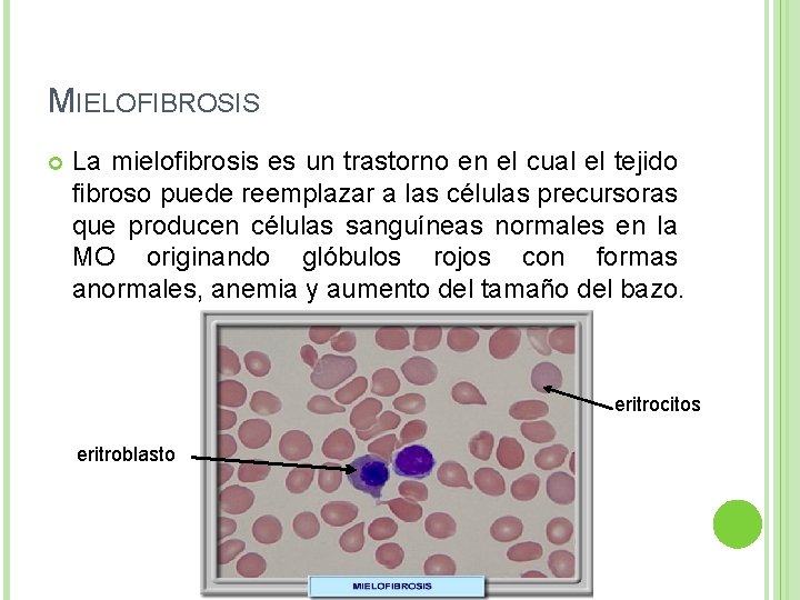 MIELOFIBROSIS La mielofibrosis es un trastorno en el cual el tejido fibroso puede reemplazar