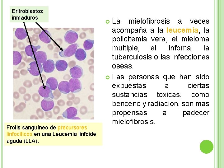 Eritroblastos inmaduros Frotis sanguíneo de precursores linfociticos en una Leucemia linfoide aguda (LLA). La
