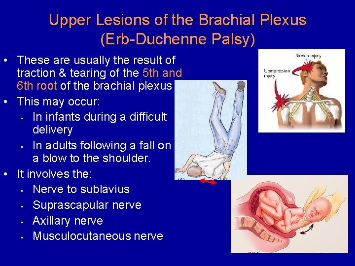Upper Lesions of the Brachial Plexus (Erb-Duchenne Palsy) • These are usually the result