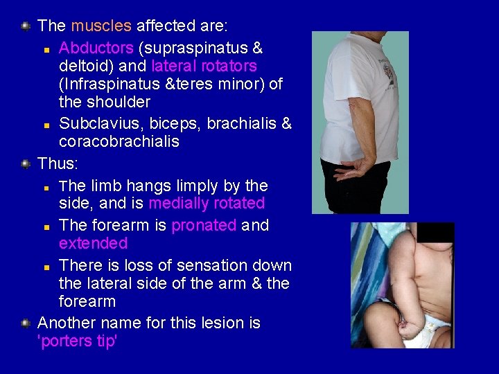 The muscles affected are: n Abductors (supraspinatus & deltoid) and lateral rotators (Infraspinatus &teres