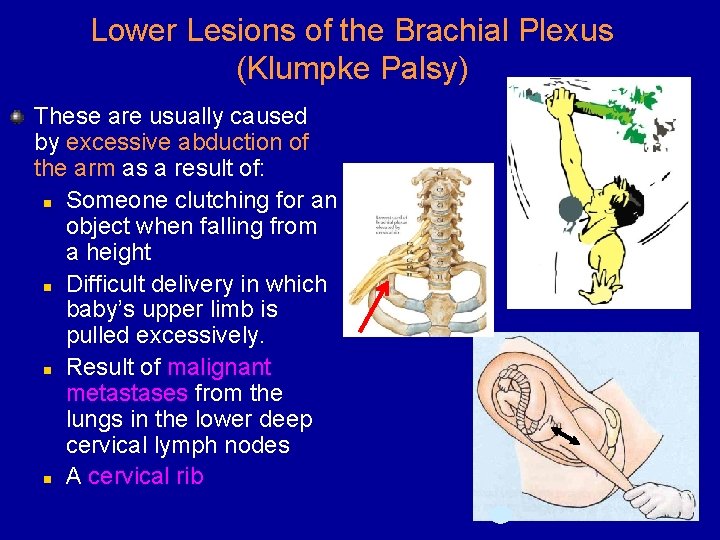 Lower Lesions of the Brachial Plexus (Klumpke Palsy) These are usually caused by excessive