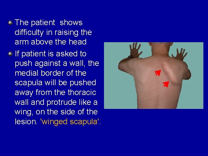 The patient shows difficulty in raising the arm above the head If patient is
