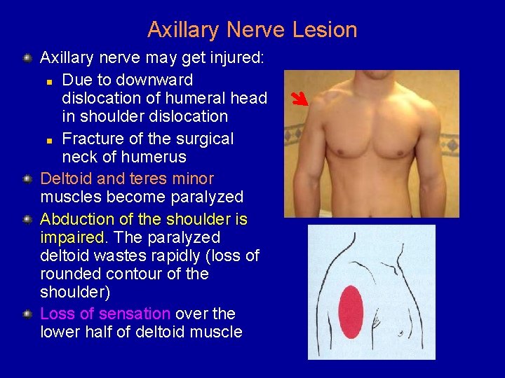 Axillary Nerve Lesion Axillary nerve may get injured: n Due to downward dislocation of