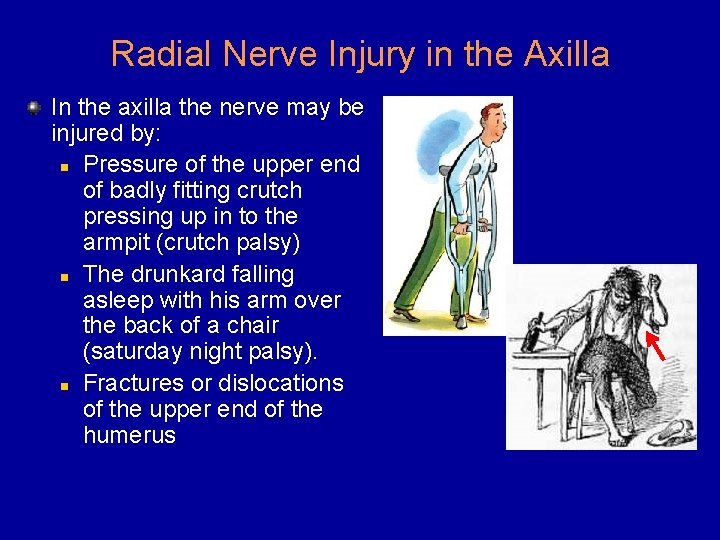 Radial Nerve Injury in the Axilla In the axilla the nerve may be injured