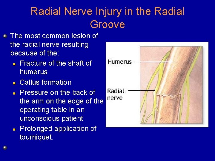 Radial Nerve Injury in the Radial Groove The most common lesion of the radial