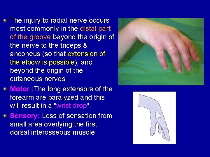 The injury to radial nerve occurs most commonly in the distal part of the