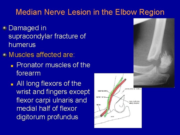 Median Nerve Lesion in the Elbow Region Damaged in supracondylar fracture of humerus Muscles