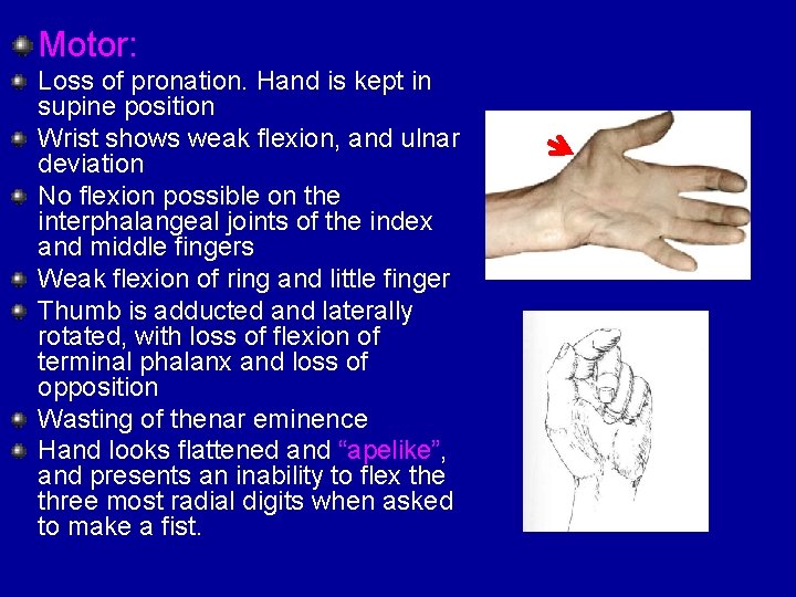 Motor: Loss of pronation. Hand is kept in supine position Wrist shows weak flexion,