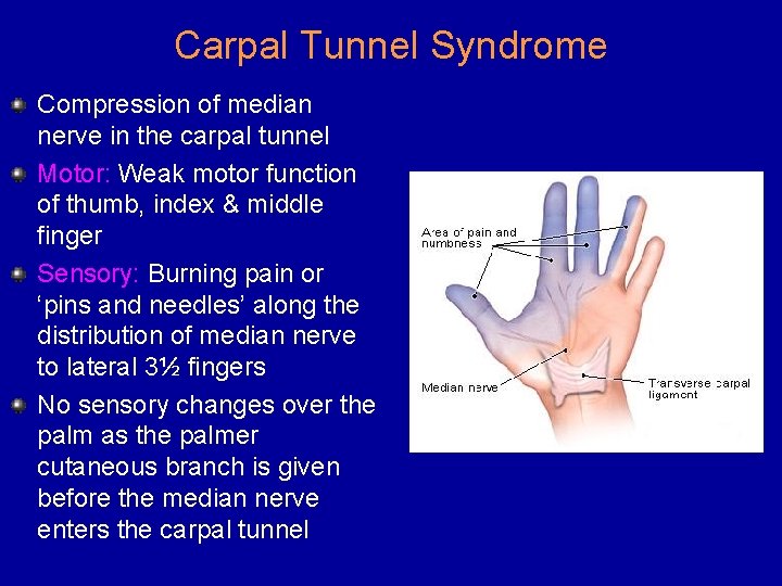 Carpal Tunnel Syndrome Compression of median nerve in the carpal tunnel Motor: Weak motor