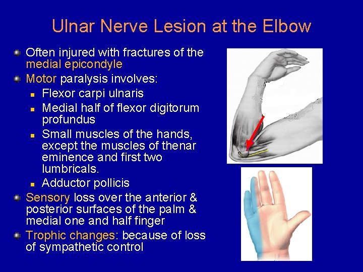 Ulnar Nerve Lesion at the Elbow Often injured with fractures of the medial epicondyle