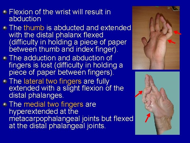 Flexion of the wrist will result in abduction The thumb is abducted and extended
