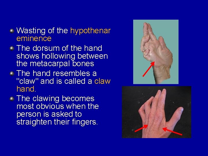 Wasting of the hypothenar eminence The dorsum of the hand shows hollowing between the