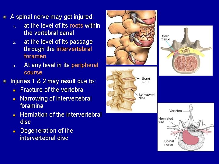 A spinal nerve may get injured: 1. at the level of its roots within