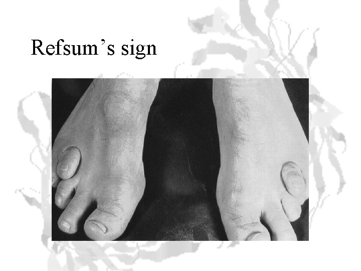 Refsum’s sign 
