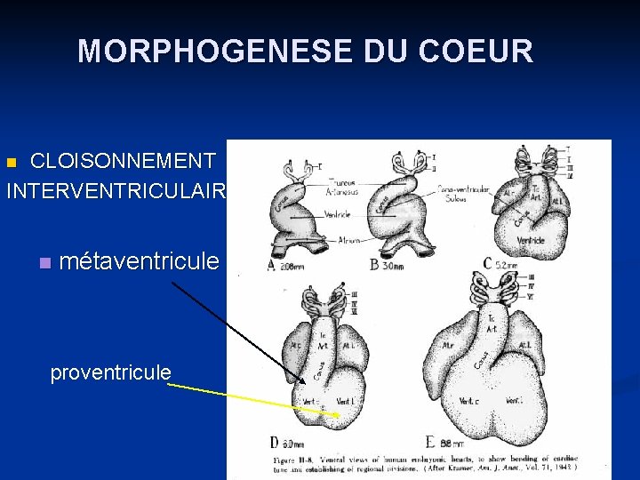 MORPHOGENESE DU COEUR CLOISONNEMENT INTERVENTRICULAIRE n n métaventricule proventricule 