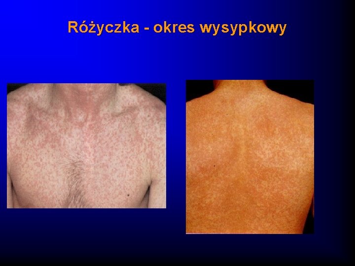 Różyczka - okres wysypkowy 