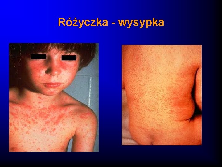 Różyczka - wysypka 