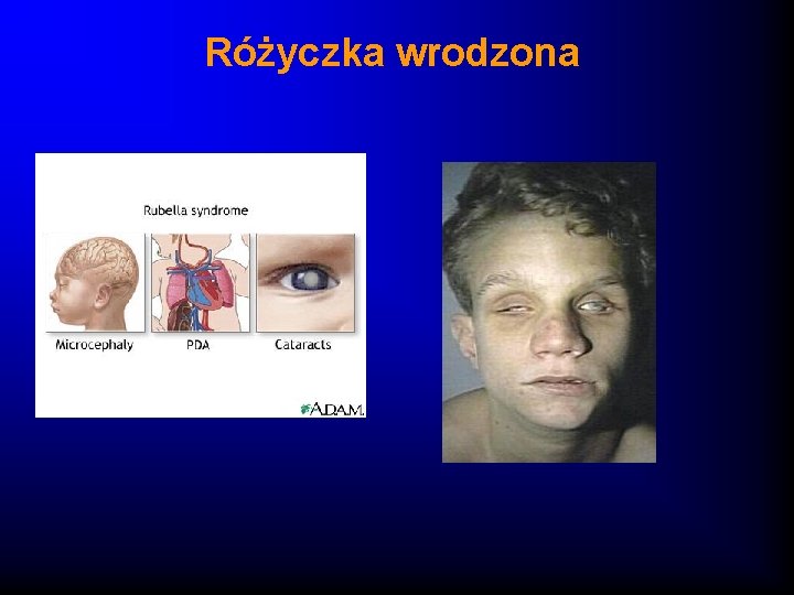 Różyczka wrodzona 