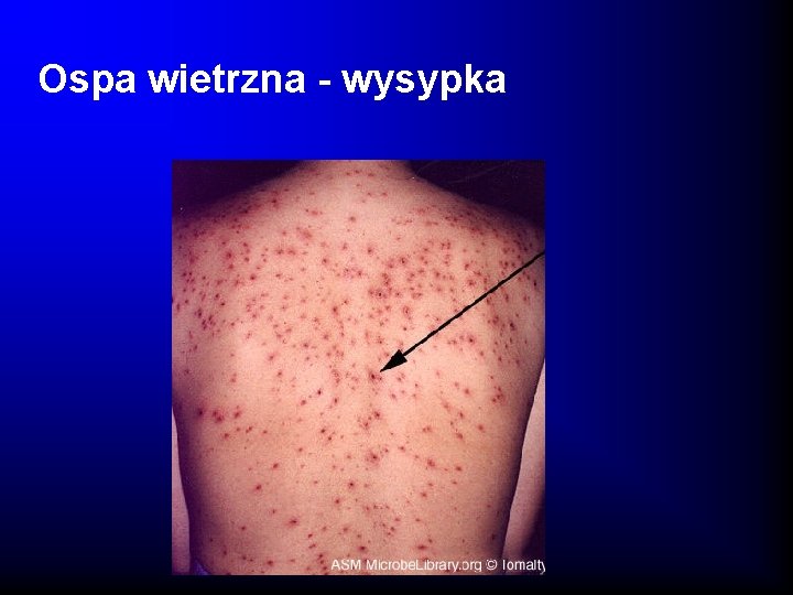 Ospa wietrzna - wysypka 