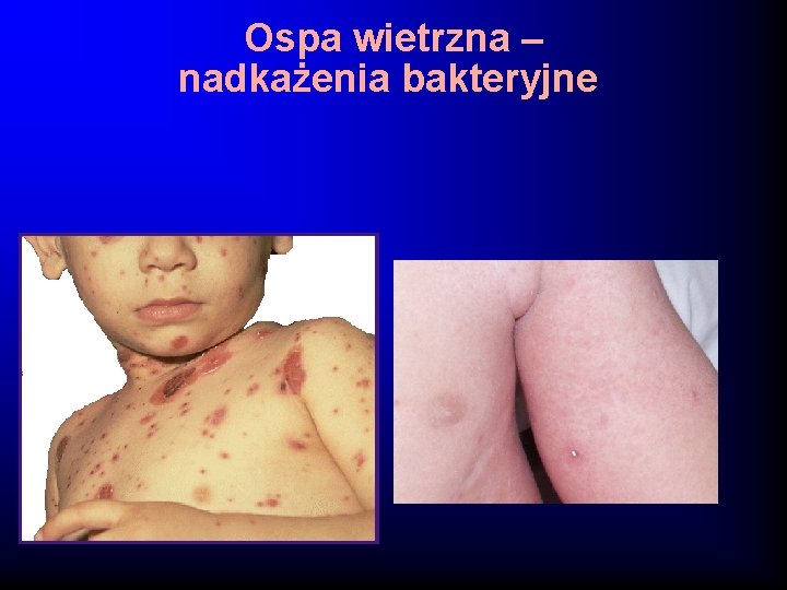 Ospa wietrzna – nadkażenia bakteryjne 