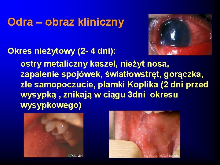 Odra – obraz kliniczny Okres nieżytowy (2 - 4 dni): ostry metaliczny kaszel, nieżyt