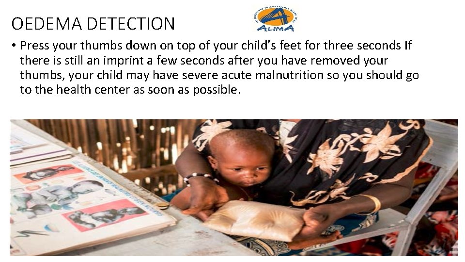 OEDEMA DETECTION • Press your thumbs down on top of your child’s feet for OEDEMA DETECTION • Press your thumbs down on top of your child’s feet for