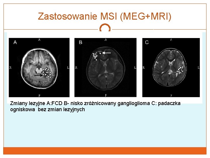 Zastosowanie MSI (MEG+MRI) Zmiany lezyjne A: FCD B- nisko zróżnicowany ganglioma C: padaczka ogniskowa