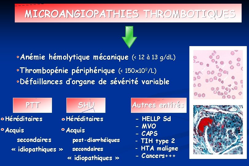 MICROANGIOPATHIES THROMBOTIQUES Anémie hémolytique mécanique (< 12 à 13 g/d. L) Thrombopénie périphérique (<