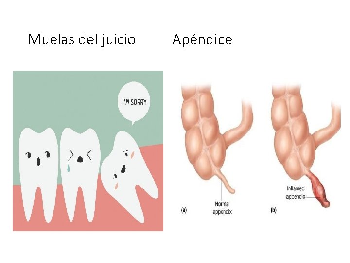 Muelas del juicio Apéndice 