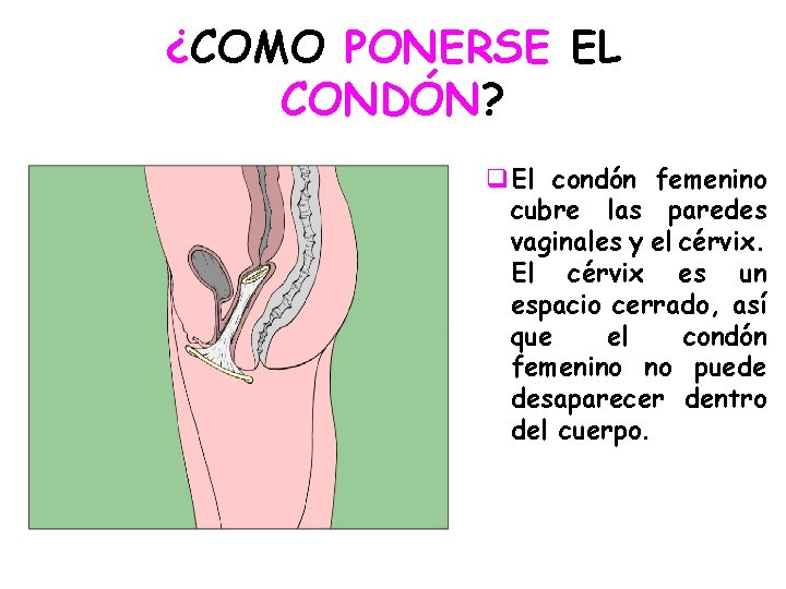 ¿COMO PONERSE EL CONDÓN? q. El condón femenino cubre las paredes vaginales y el