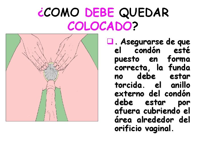¿COMO DEBE QUEDAR COLOCADO? q. Asegurarse de que el condón esté puesto en forma