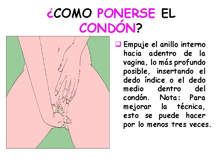 ¿COMO PONERSE EL CONDÓN? q Empuje el anillo interno hacia adentro de la vagina,