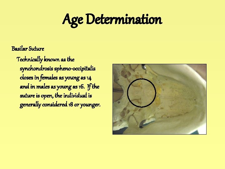 Age Determination Basilar Suture Technically known as the synchondrosis spheno-occipitalis closes in females as