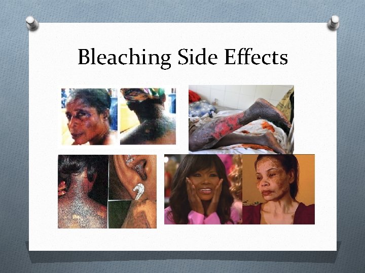 Bleaching Side Effects 