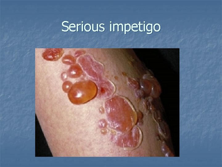 Serious impetigo 