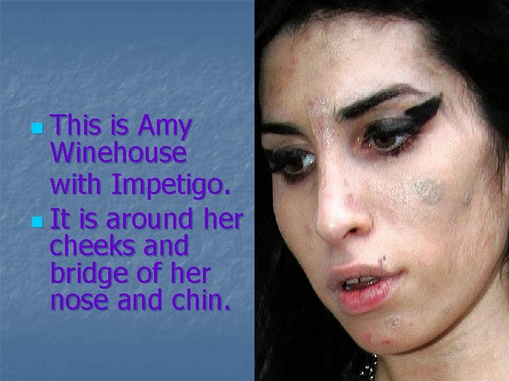 n This is Amy Winehouse with Impetigo. n It is around her cheeks and