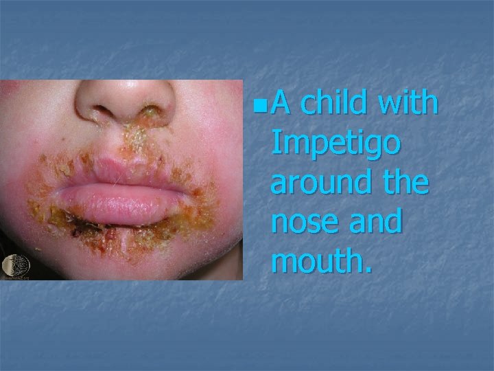n. A child with Impetigo around the nose and mouth. 
