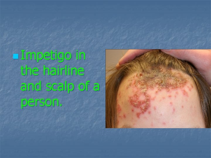 n Impetigo in the hairline and scalp of a person. 