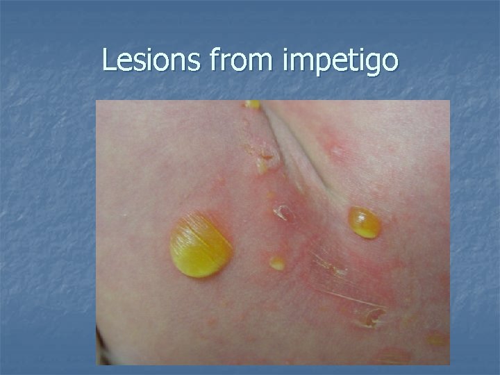 Lesions from impetigo 