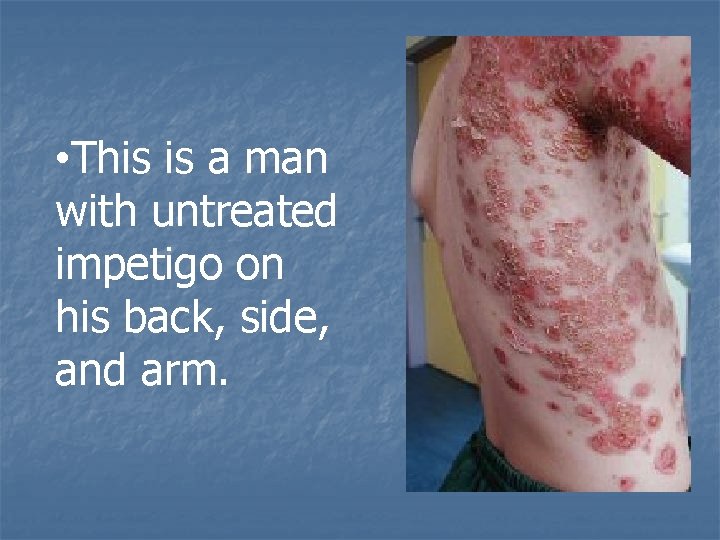  • This is a man with untreated impetigo on his back, side, and