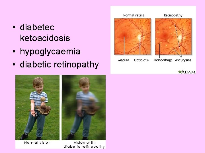  • diabetec ketoacidosis • hypoglycaemia • diabetic retinopathy 