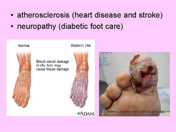  • atherosclerosis (heart disease and stroke) • neuropathy (diabetic foot care) 